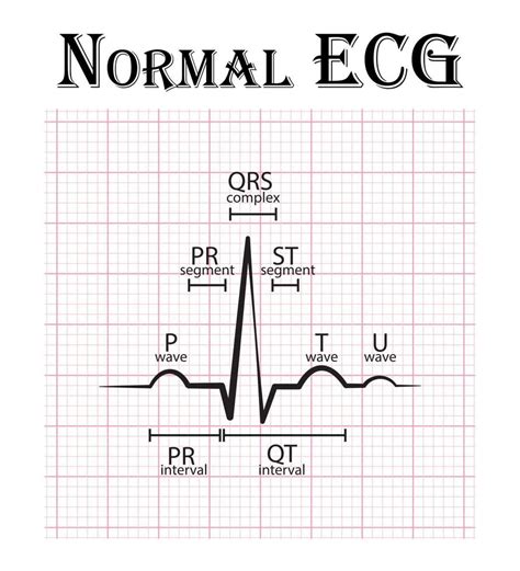 normal ecg sample|normal ecg graph images.
